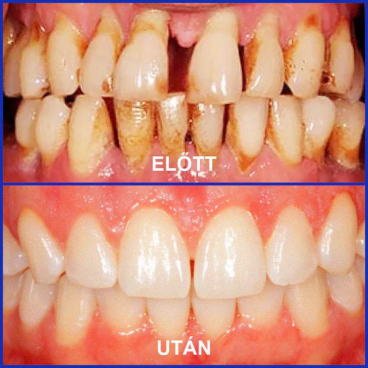 Furzero® 𝑭𝒐𝒄𝒖𝒔𝒔𝒎𝒊𝒍𝒆 – Méhméreges szájápoló por 🦷🦷