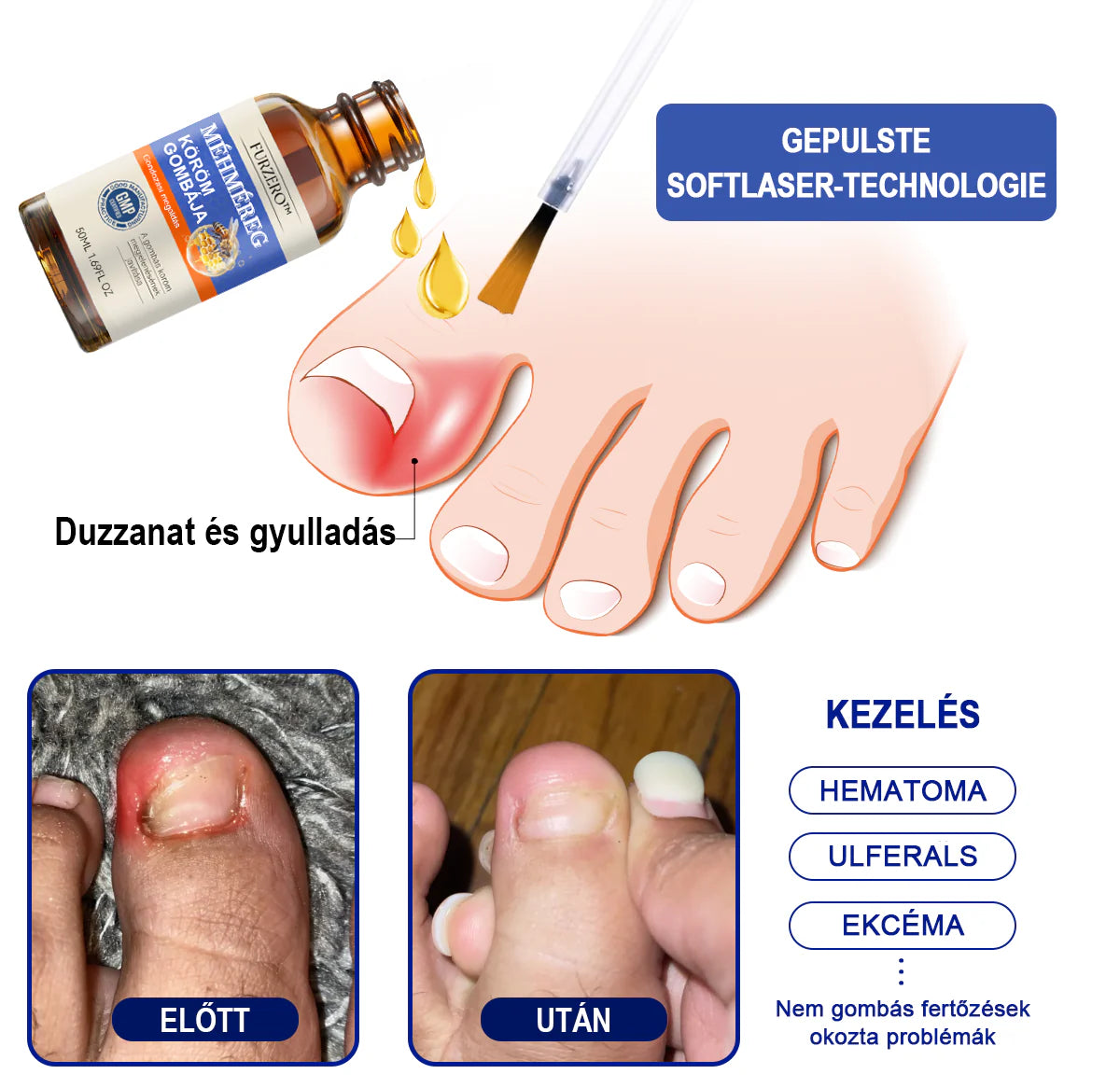 🐝Furzero™ Méhméreg Körömgomba Kezelőoldat: Teljes megoldás a körömgomba problémájára🌟👣👣（Az utánvétes fizetést）