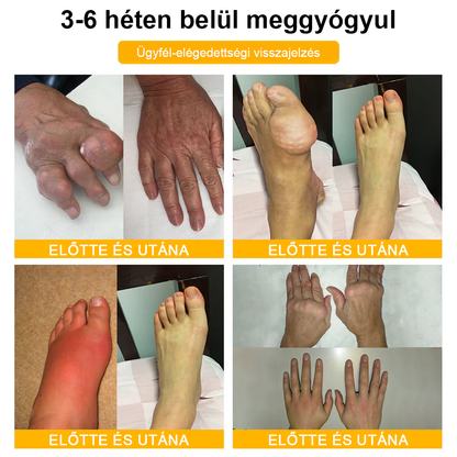 💎TLOPA® Botulinum Toxin és Méhméreg Fájdalomcsillapító Csontgyógyító Krém🐝 🔥(Kifejezetten időseknek & ortopéd szakorvosok ajánlásával)🦴